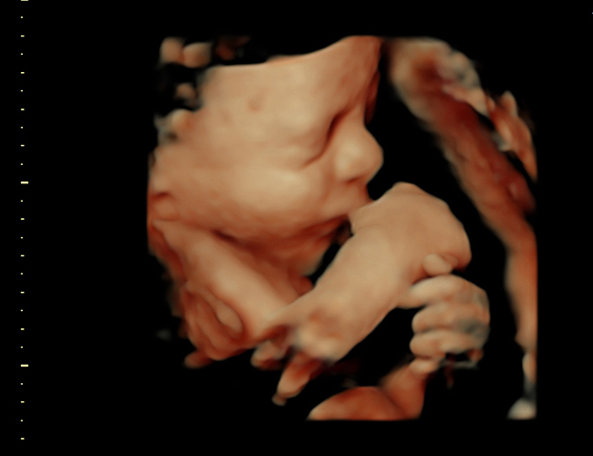 3D ultrasound image at 31 weeks